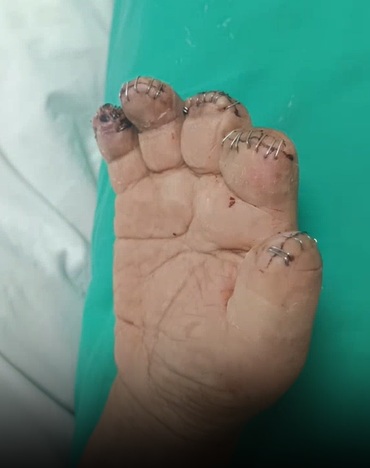 Mujer fue a cirugía de cálculos biliares y termino amputada de pies y manos en el hospital de Los Ángeles 