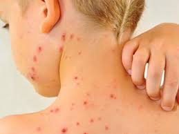 Ministerio de Salud confirma caso importado de sarampión en Chile