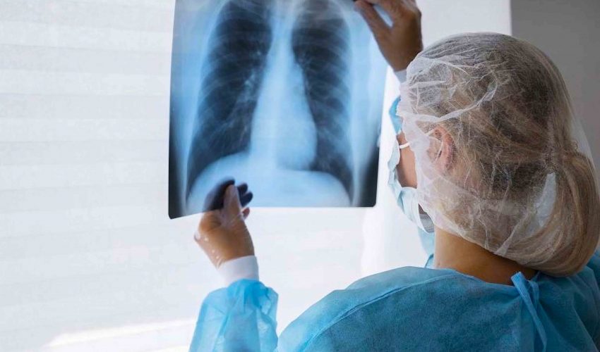 Biobío: Tuberculosis registra baja de 21% en últimos años debido a efectivo diagnóstico precoz