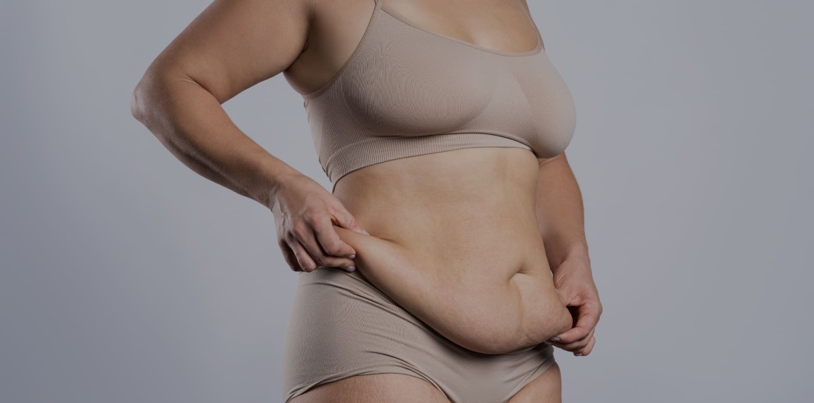 Bono PAD de Fonasa para abdomen flácido, (Guatita de delantal): Esto debe pagar el paciente