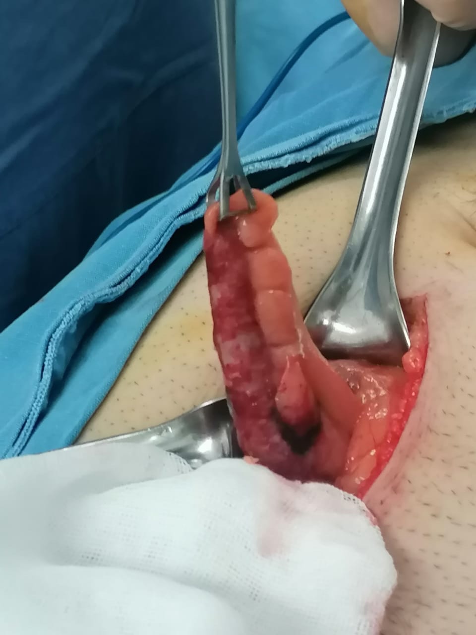 ¿El apéndice es realmente innecesario en el cuerpo? Esto dice la ciencia