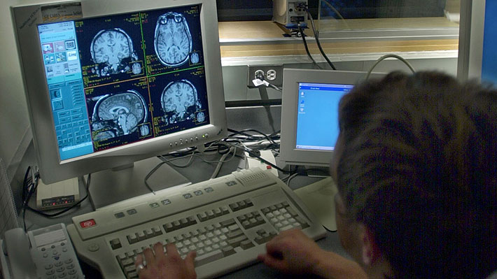 Científicos descubren el mecanismo de las células tumorales para alterar el cerebro y lograr diseminar el cáncer  