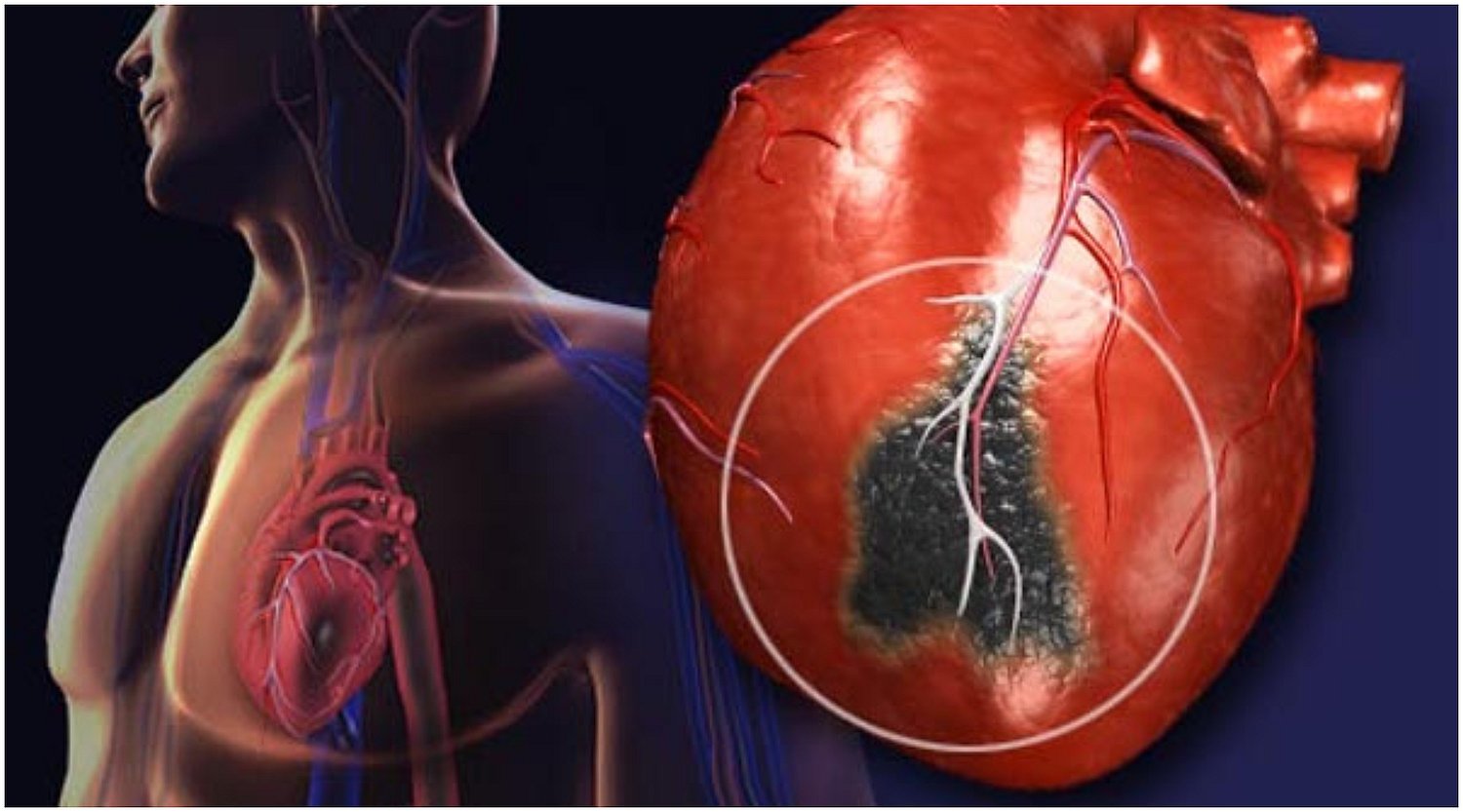 No son iguales: los síntomas de infarto en hombres y mujeres